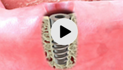 Dental Implant