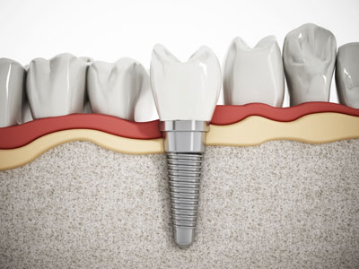 Mini-Dental Implants
