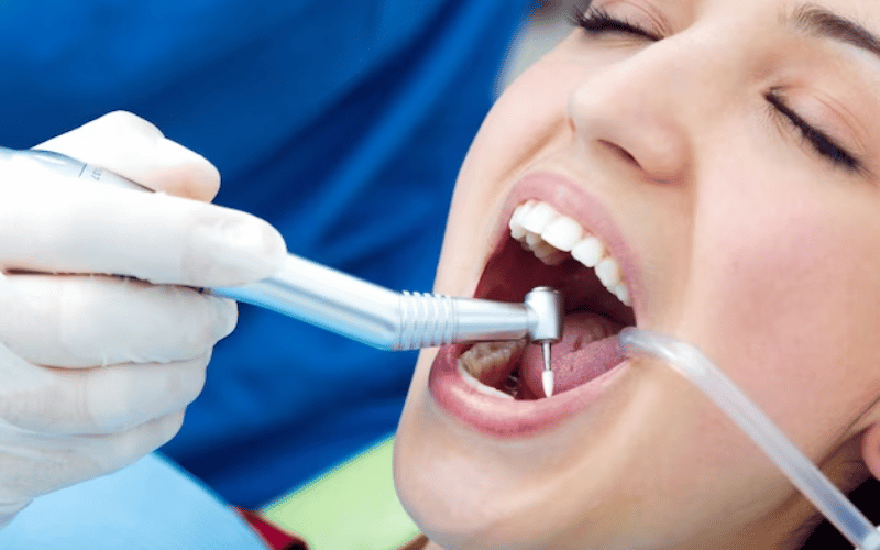 Dental Restorations and Their Lifespan