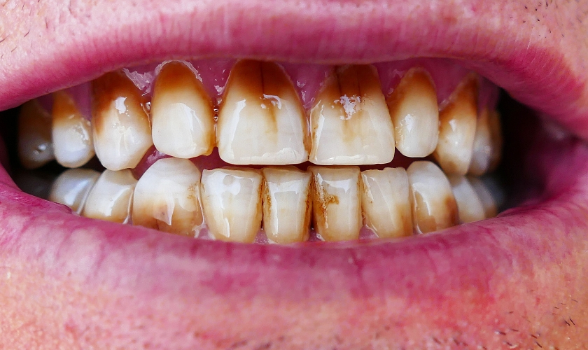 How to Remove Coffee Stains from Teeth