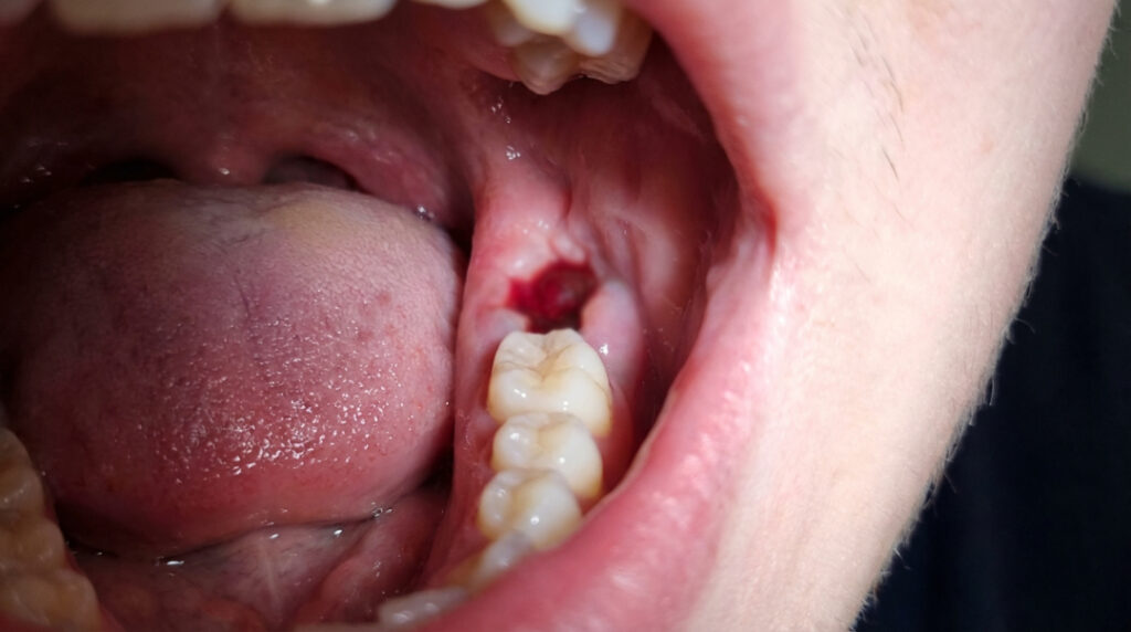 Understanding the Healing Process After Wisdom Teeth Extraction